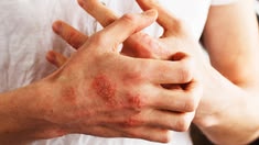 Dermatology